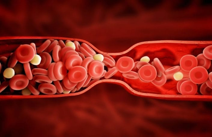 Arterias obstruidas