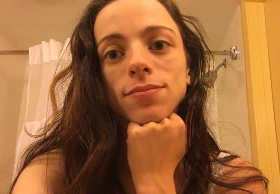 Brenda with effect of the lipoatrophy