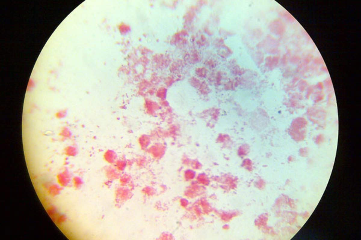 Emerging Gonorrhea Antibiotic Resistance Could Lead to Incurable Strain