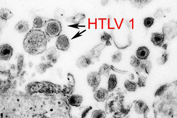 HIV S Largely Ignored Relative HTLV 1 Has Prevalence Rates Of Up To   Htlv 1 