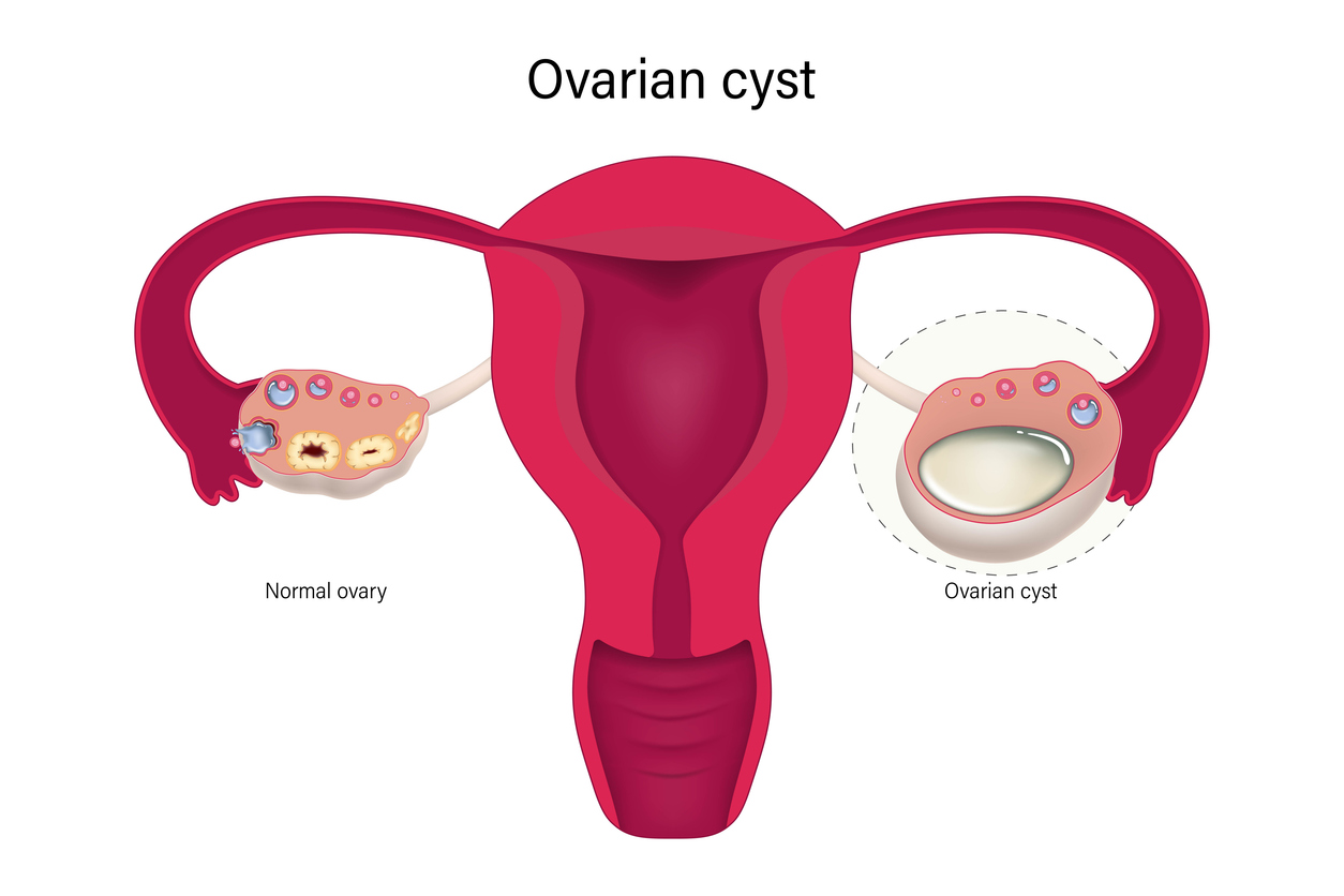 Ovarian Cysts