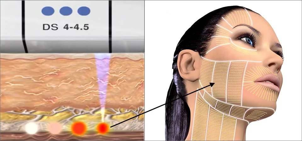 Kaksi eri kuvaa siitä miten ultherapy vaikuttaa ihoon ja miten sen vaikutus näkyy naisen kasvoilla