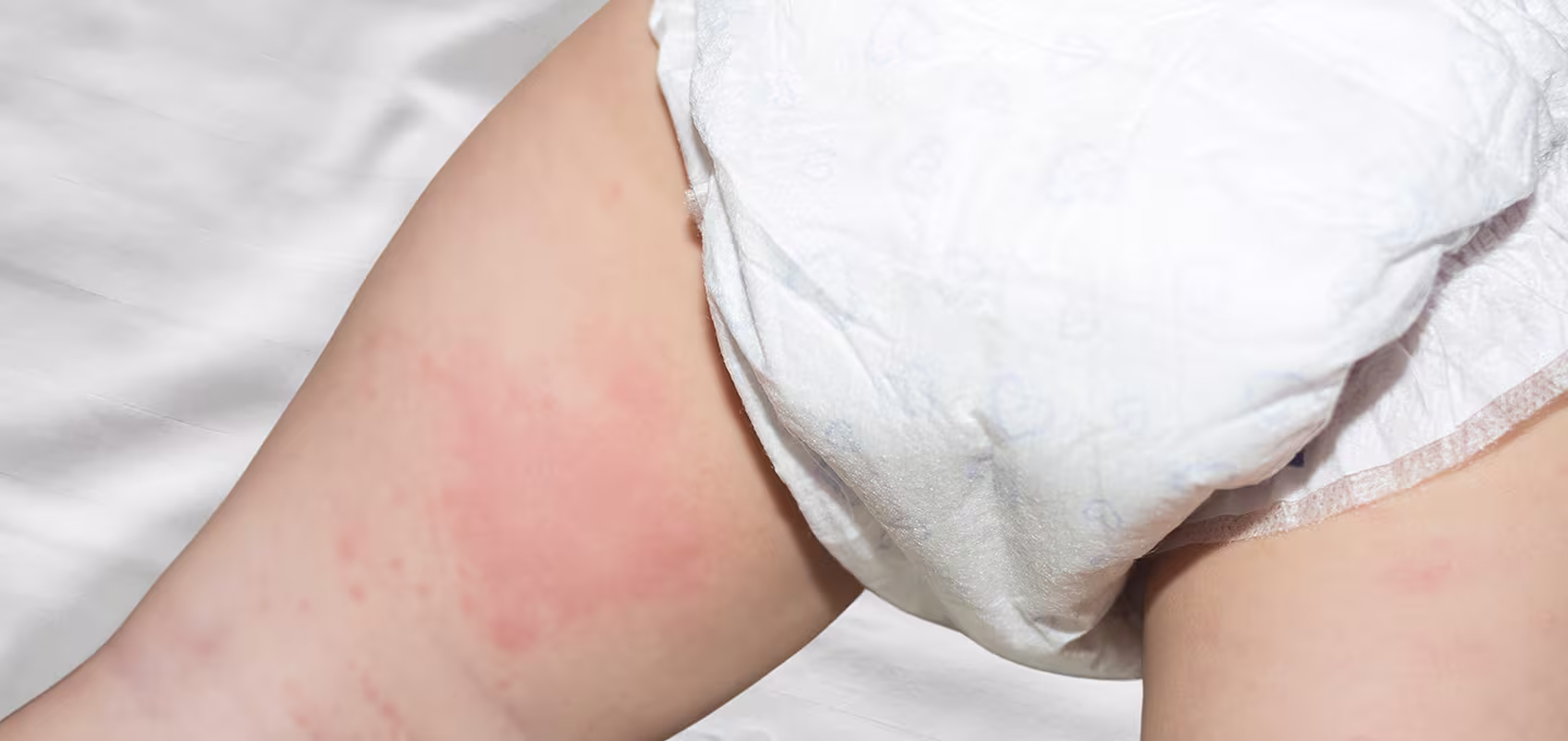 Close-up of a baby’s skin showing red, irritated diaper rash around the diaper area.