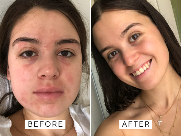 BEFORE AND AFTER LA ROCHE POSAY