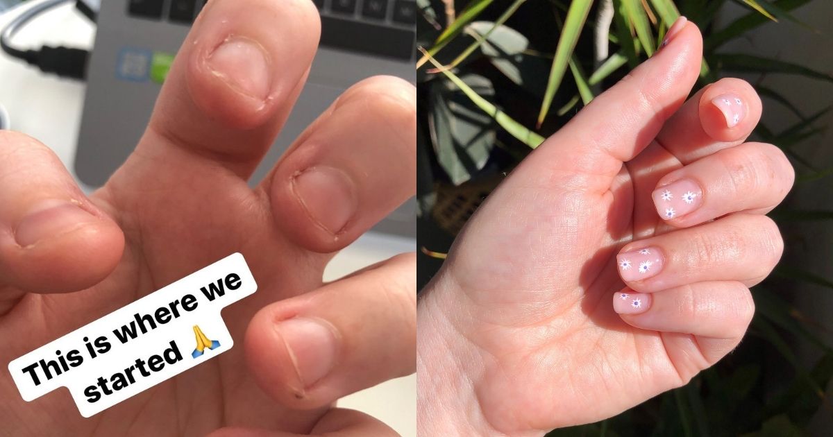 How to Stop Nail Biting: After 20 Years, This Is How I Finally Broke My  Biting Habit