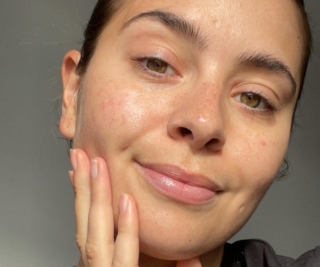 7 Things I've Learnt About Managing Acne After Coming off the Pill