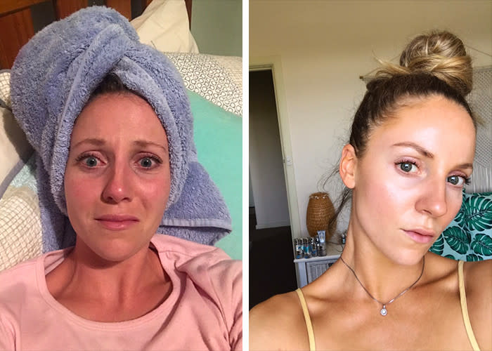 before-and-after - My Routine for Brightening Sun-Damaged, Pigmented Skin