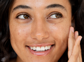 How to Heal Acne Scars