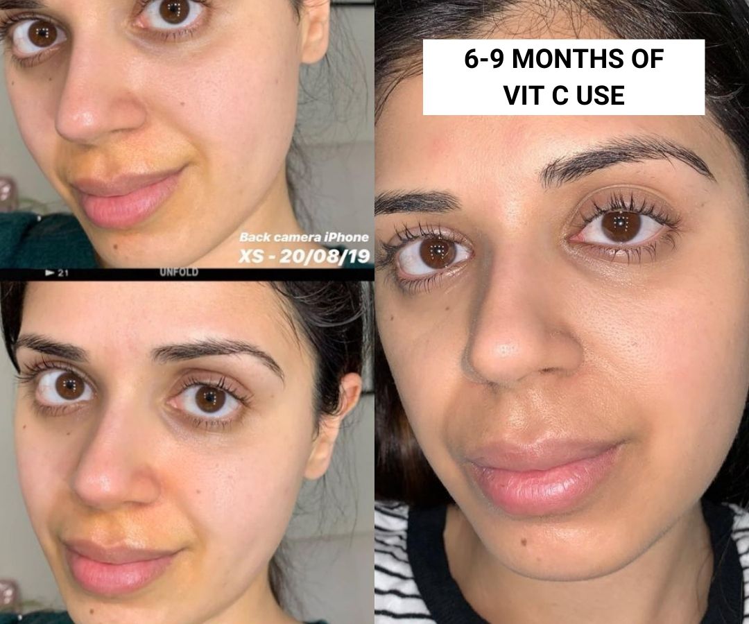 Vitamin C Serum Before and After Pictures