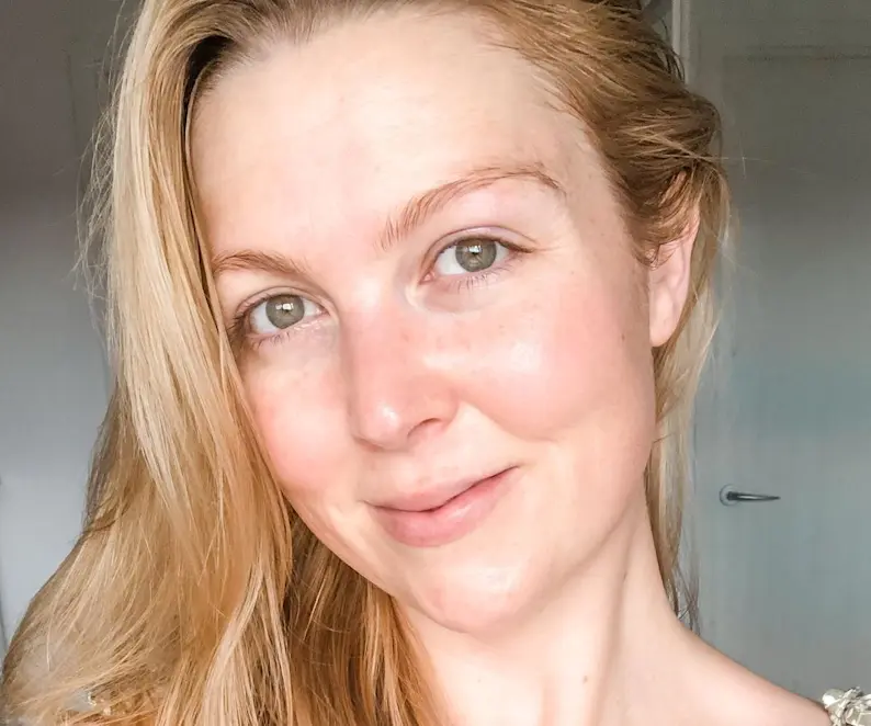 Perioral Dermatitis Skin Care Tips for Calmer, Clearer Skin