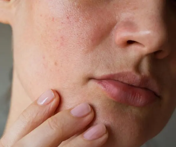 A Dermal Therapist on What Will (& Won’t) Make Enlarged Pores Look Smaller