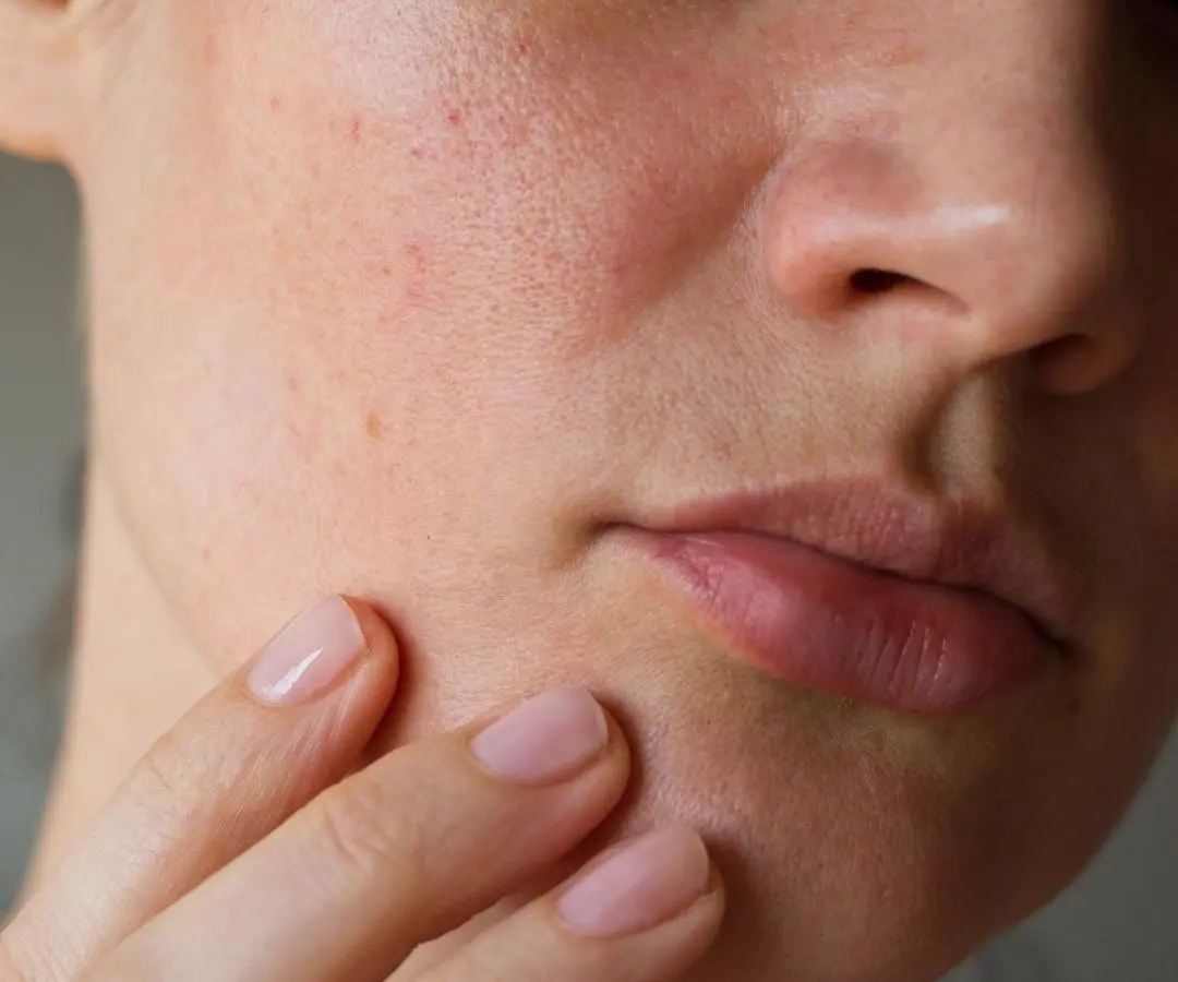 A Dermal Therapist on What Will (& Won’t) Make Enlarged Pores Look Smaller