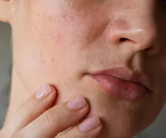 A Dermal Therapist on What Will (& Won’t) Make Enlarged Pores Look Smaller