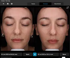 Beauty IQ Article - bridal-skincare-routine-visia