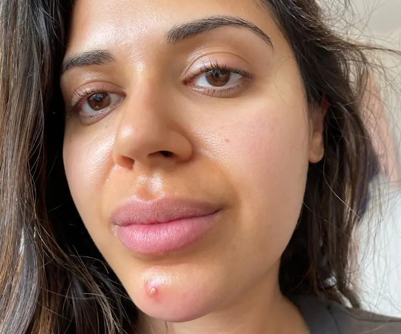 How to Get Rid of Pimples Overnight: Quick Tips - Adore Beauty