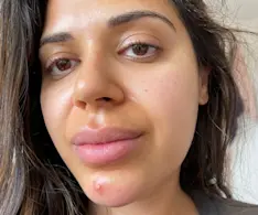 Beauty IQ Article - How to Get Rid of Pimples Overnight: Quick Tips - Adore Beauty