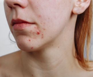 Literally Every Single Question You Ve Ever Had About Hormonal Acne Answered