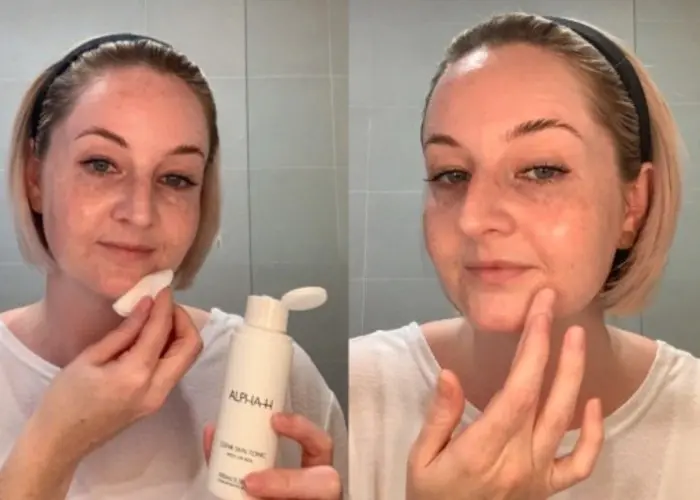 How To Treat Acne Prone Skin Using Alpha-H Skin Care Products