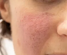 Beauty IQ Article - Every Question You’ve Ever Had About Rosacea Flare Ups, Answered