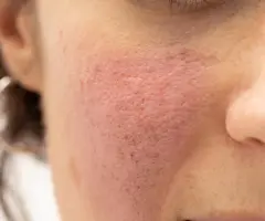 Every Question You’ve Ever Had About Rosacea Flare Ups, Answered