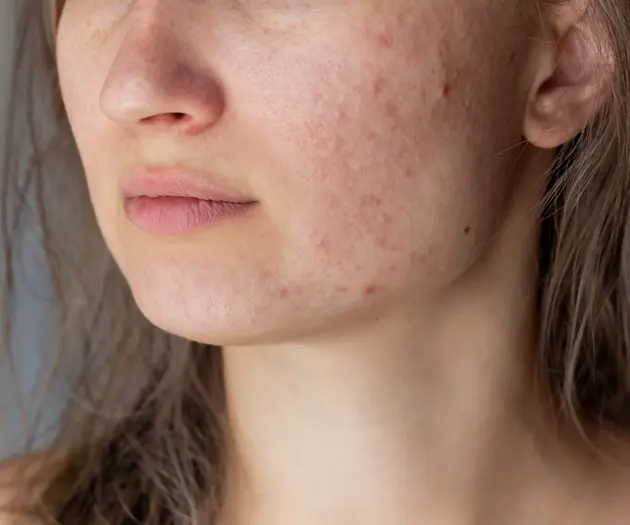Clearing The Confusion: Common Culprits Behind Your Breakouts
