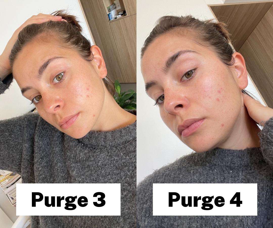 Everything I Learnt Trying Prescription Retinoids in My Skin Routine