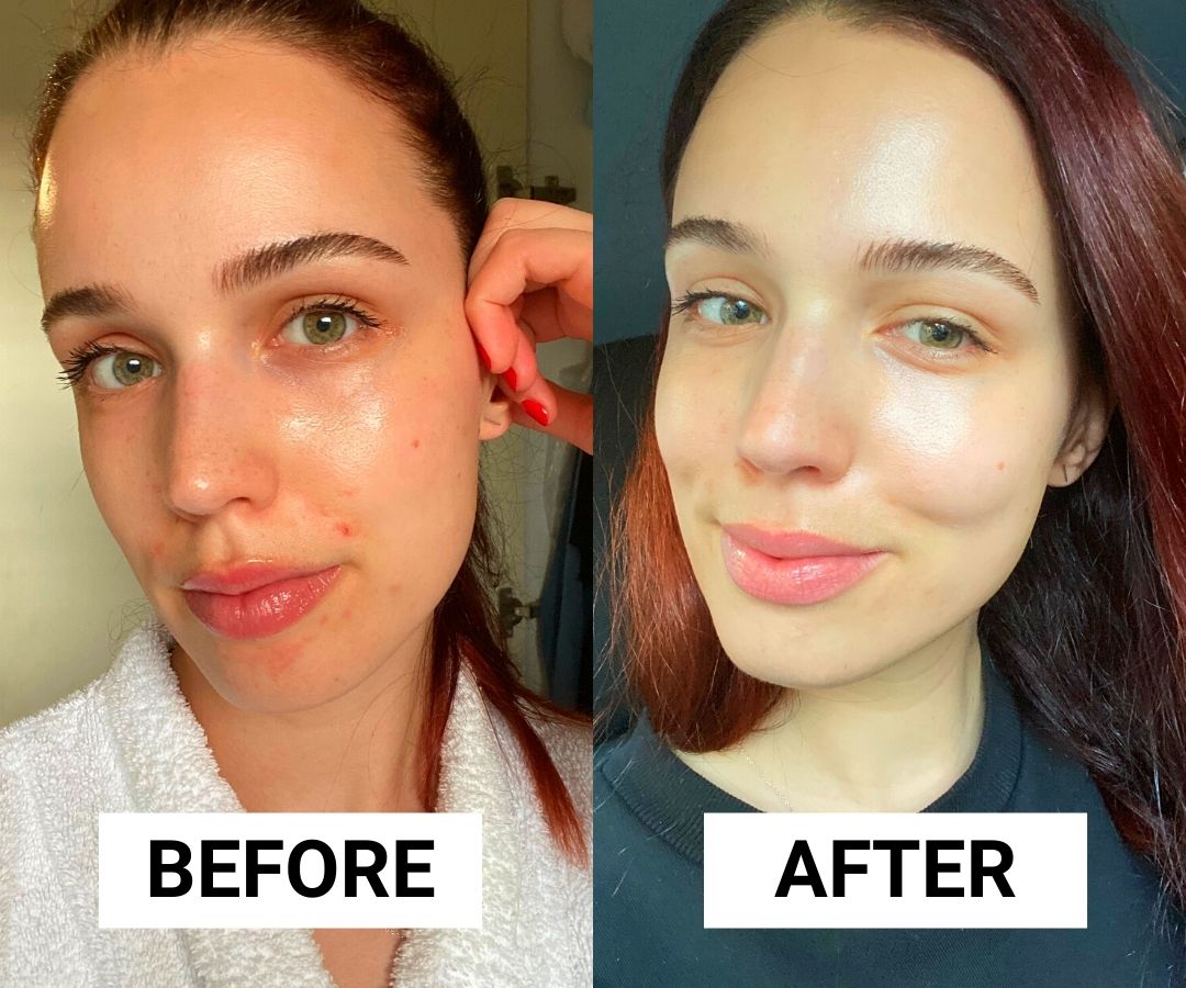This Cleanser and Duo Healed Breakouts in a Week