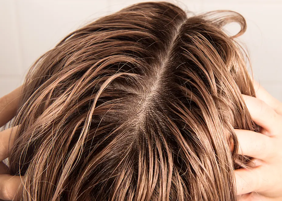 Soothe Irritated Skin with the Best Shampoos for a Sensitive Scalp in Australia