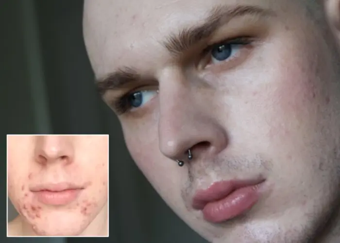 A Beauty Blogger’s Guide To Reducing and Preventing Acne