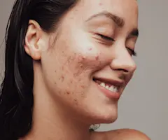 Best skincare acne under $100