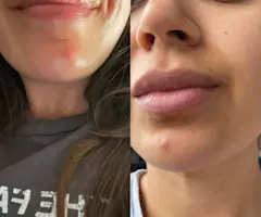 VIDEO: How I Fixed a HUGE Pimple in 48 Hours! | How To Get Rid of a Pimple Fast