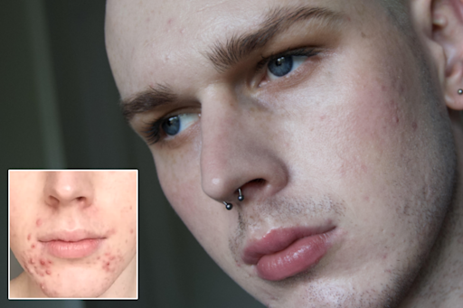 A Beauty Blogger’s Guide To Reducing and Preventing Acne