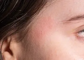 A Real Life Guide To Effectively Dealing With Dermatitis & Eczema