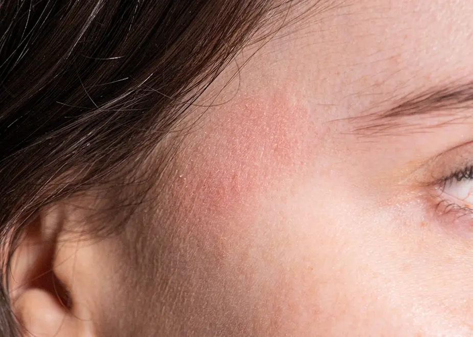 A Real Life Guide To Effectively Dealing With Dermatitis & Eczema