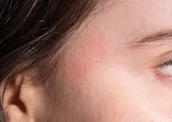 Beauty IQ Article - guide-to-effectively-dealing-with-dermatitis-eczema