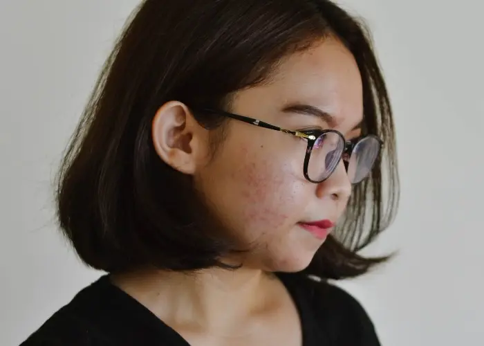 Ultimate How-To: Makeup for Sensitive Acne Prone Skin