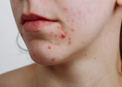 Beauty IQ Article - 8 Best Spot Treatment for Pimples