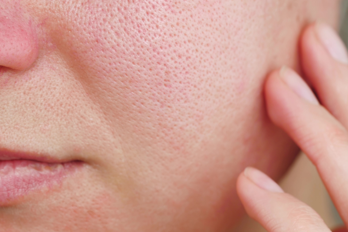 Adobe Stock - large open pores and red blotchy skin - 1200 x 800