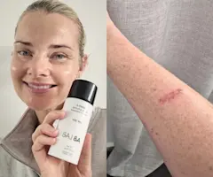 How not wearing sunscreen can cause serious damage like skin cancer, One Adore Beauty shares her skin cancer story.