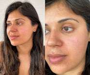 Exactly How I Fixed My Destroyed Skin Barrier In A Week