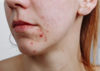 Literally Every Single Question You've Ever Had About Hormonal Acne, Answered