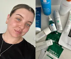 Skincare That’s Been Great for My Breakout-Prone Skin