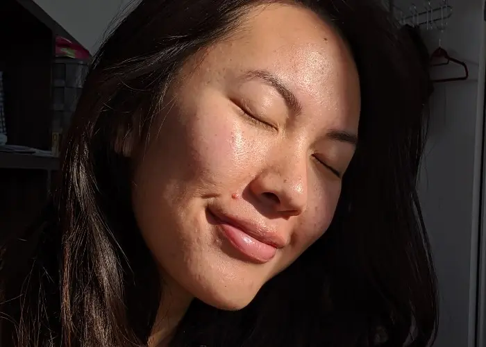 Podcast Ep 34: Treating Acne Scarring With A Dermatologist