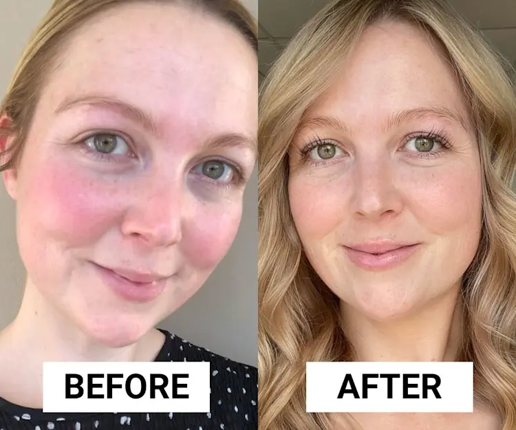 The Serum That Reduced the Appearance of My Rosacea Redness in 3 Months