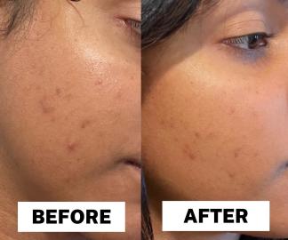 Murad Rapid Dark Spot Correcting Serum review before and after picture