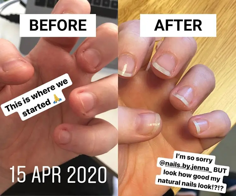 How to Stop Nail Biting After 20 Years, This Is How I Finally Broke My