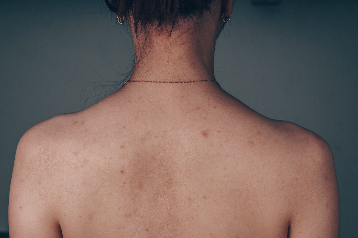 How to Get Rid of Back Acne Scars Effectively - Adore Beauty
