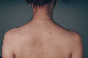 How to Get Rid of Back Acne Scars Effectively - Adore Beauty