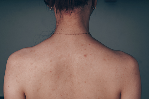 Beauty IQ Article - How to Get Rid of Back Acne Scars Effectively - Adore Beauty