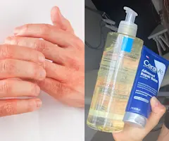 Eczema Flare-Ups Explained: The Triggers You Might Be Missing